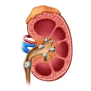 Kidney Stones in Infant's & Children's