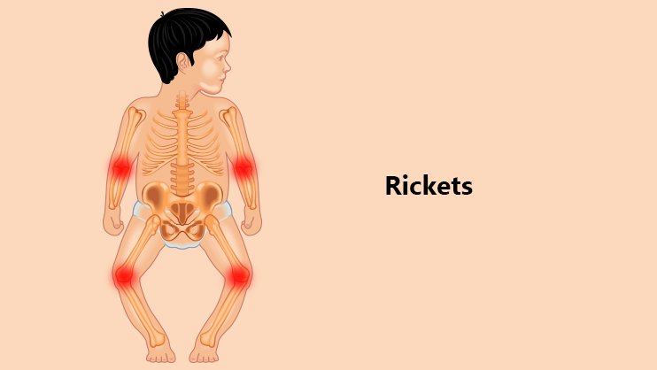 Rickets Treatment, Causes & Symptoms